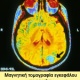 Εγκεφαλικοί όγκοι, γλοιώματα, ακτινοθεραπεία και χημειοθεραπεία
