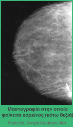 Μαστογραφία στην οποία φαίνεται καρκίνος (κάτω δεξιά)