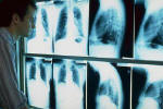 Η ακτινογραφία του θώρακα μπορεί να δείξει τις βλάβες που προκαλεί ο αμίαντος στο αναπνευστικό σύστημα.