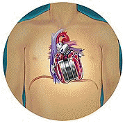 Σχηματική απεικόνιση ασθενούς, που έχει εμφυτευμένη στη θέση της φυσιολογικής καρδίας, την αυτόνομη τεχνητή καρδία Abiocor.