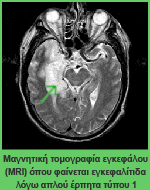 Η μηνιγγίτιδα είναι η φλεγμονή των μεμβρανών που περιβάλλουν τον εγκέφαλο και το νωτιαίο μυελό.