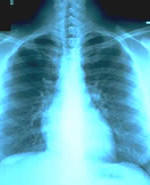 Παθήσεις των πνευμόνων είναι δυνατόν να προκαλούν κακοσμία της αναπνοής