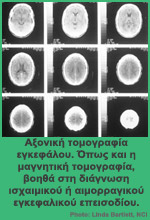 Τα εγκεφαλικά επεισόδια αποτελούν την τρίτη συχνότερη αιτία θανάτου - Αξονική τομογραφία εγκεφάλου