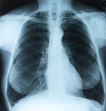 Ασπιρίνη εναντίον καρκίνου πνεύμονα: Η συστηματική λήψη ασπιρίνης μπορεί να μειώνει μέχρι και κατά 33% τον κίνδυνο για καρκίνο του πνεύμονα.
