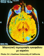 Μαγνητική τομογραφία εγκεφάλου με καρκίνο