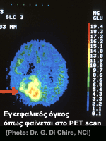 Εγκεφαλικοί όγκοι: Η έγκαιρη διάγνωση των εγκεφαλικών όγκων βελτιώνει την πρόγνωση
