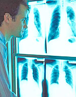 Δυστυχώς η διάγνωση του καρκίνου του πνεύμονα γίνεται συνήθως σε προχωρημένα στάδια και έτσι η πρόγνωση είναι φτωχή.