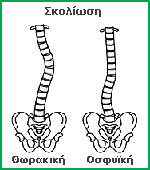 Η σκολίωση είναι η πλάγια κύρτωση της σπονδυλικής στήλης, που συγχρόνως στρίβει και τον κορμό
