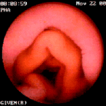 Εικόνα που λήφθηκε ενώ το βίντεο χάπι περνούσε δια μέσου του δωδεκαδάκτυλου. Η φωτογραφία λήφθηκε από το British Medical Journal, Credit Given Imaging.
